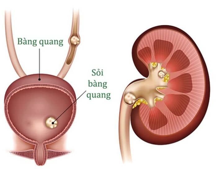 Sỏi bàng quang là một trong những bệnh nguy hiểm từ việc đi tiểu nhiều lần dẫn tới