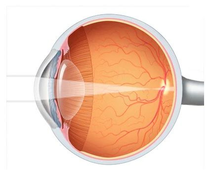 Kacamata yang digunakan untuk menolong cacat mata presbiopi adalah