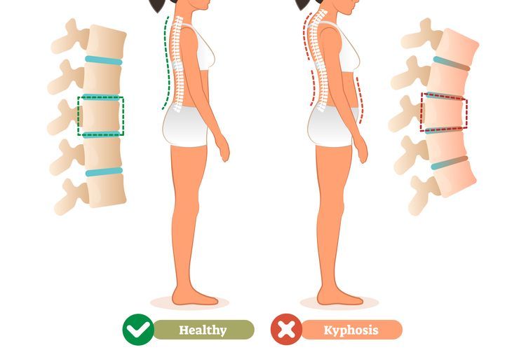 Kondisi dimana tulang belakang bagian punggung membengkok ke kiri atau ke kanan disebut kelainan tulang disebut