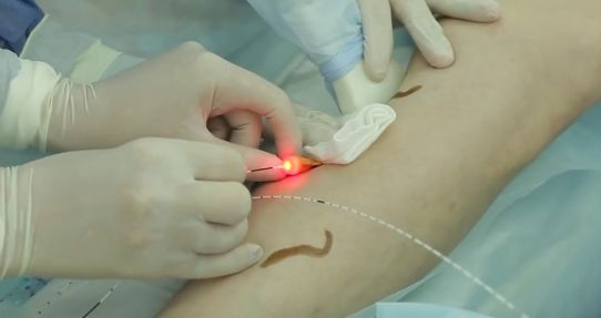 Chi phí điều trị giãn tĩnh mạch chân bằng laser là bao nhiêu?