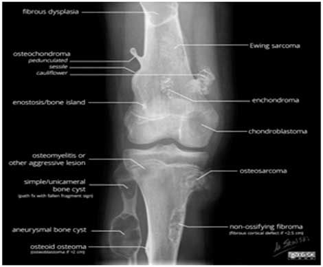 Bệnh U tế bào khổng lồ(Giant cell tumor)