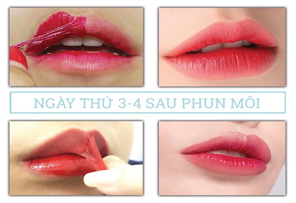 Ngày thứ 3 đến ngày thứ 4 sau phun môi