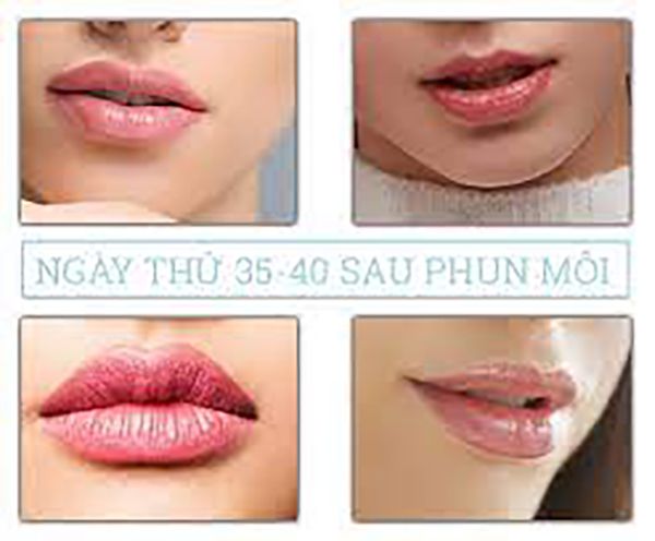 Ngày thứ 35 đến ngày thứ 40 sau phun môi