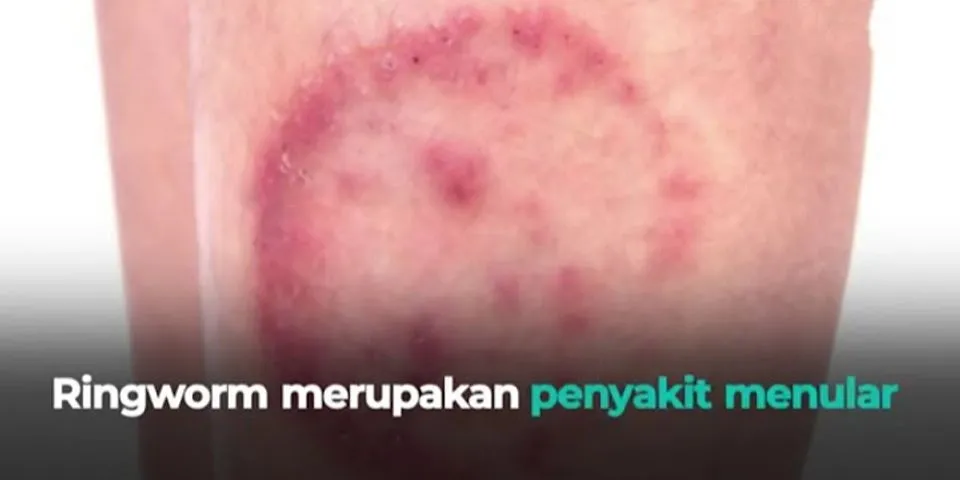 Berikut bukan penyakit yang terjadi pada kulit adalah a ringworm