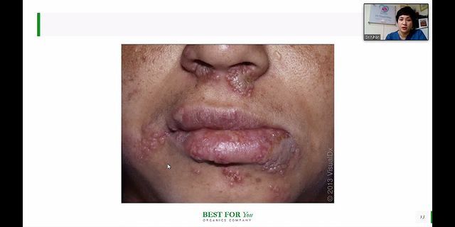 Bị herpes là gì