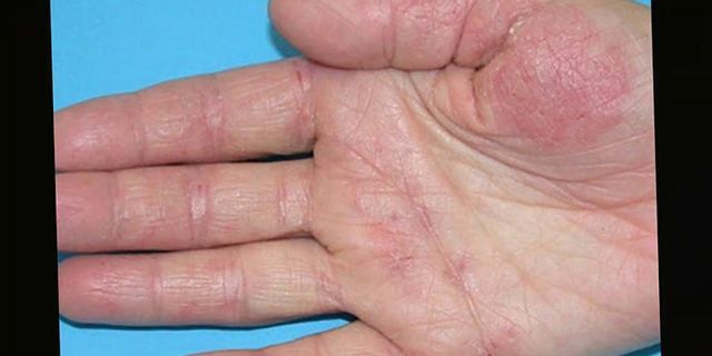 Cách chữa viêm da cơ địa ở ngón tay