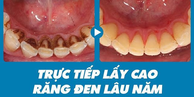 Cách lấy cao răng đen