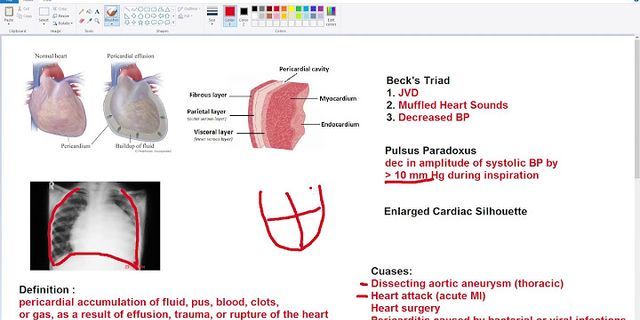 Cardiac tamponade là gì