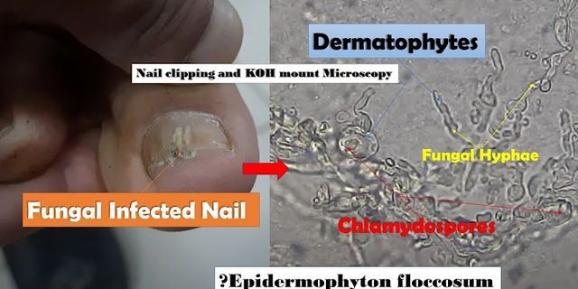 Dermatophytosis of nail