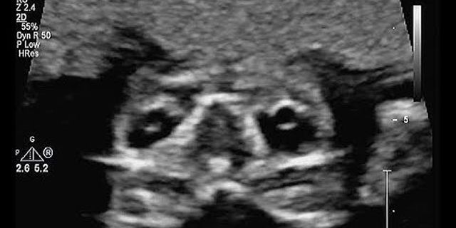 Hình ảnh siêu âm thai 16 tuần con gái