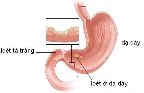 loét dạ dày hành tá tràng