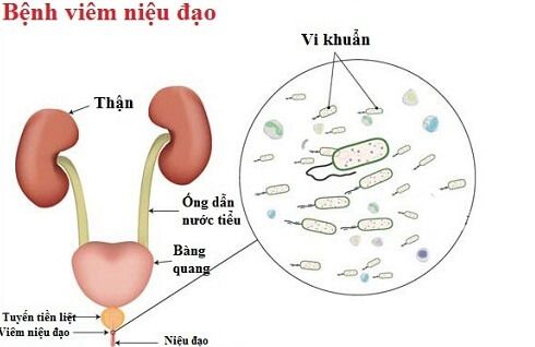 Nước tiểu có mùi hôi nặng do viêm niệu đạo