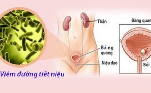 Nước tiểu có mùi nồng do viêm đường tiết niệu