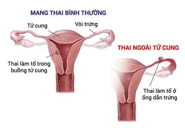 Thai ngoai tu cung co the vao tu cung duoc khong b4554a47b05e9079df8281f70b894b0c
