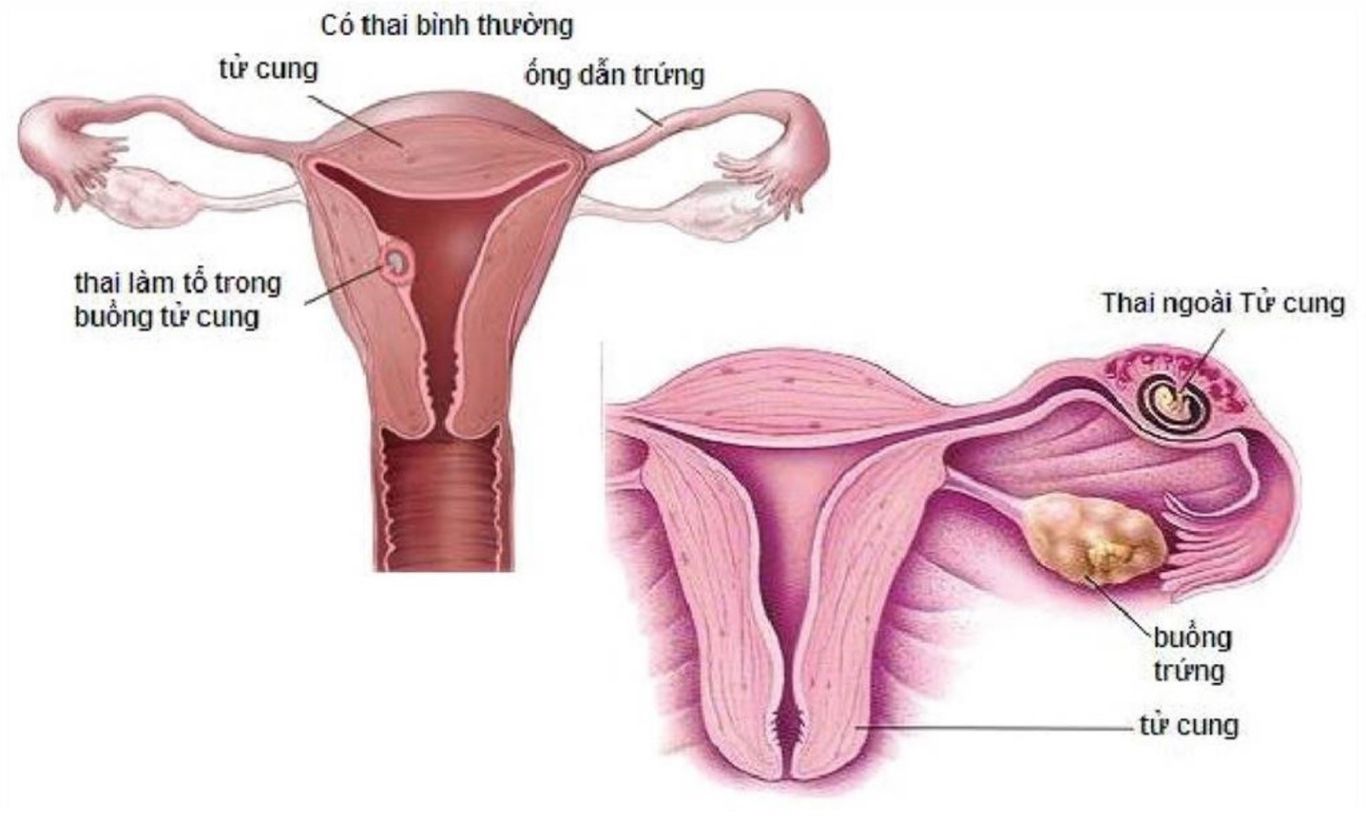 Thai ngoài tử cung là tình trạng gây chảy máu nguy hiểm cần được xử trí kịp thời