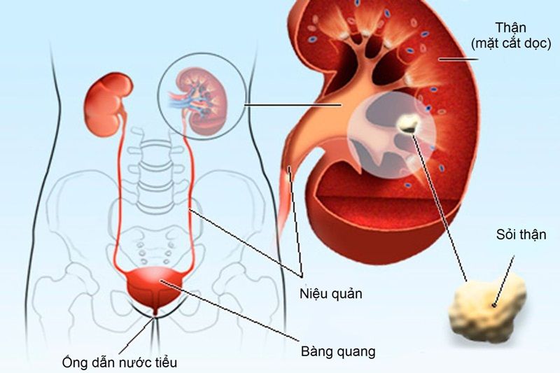 Sỏi thận là một trong những nguyên nhân dẫn đến tiểu nhiều lần